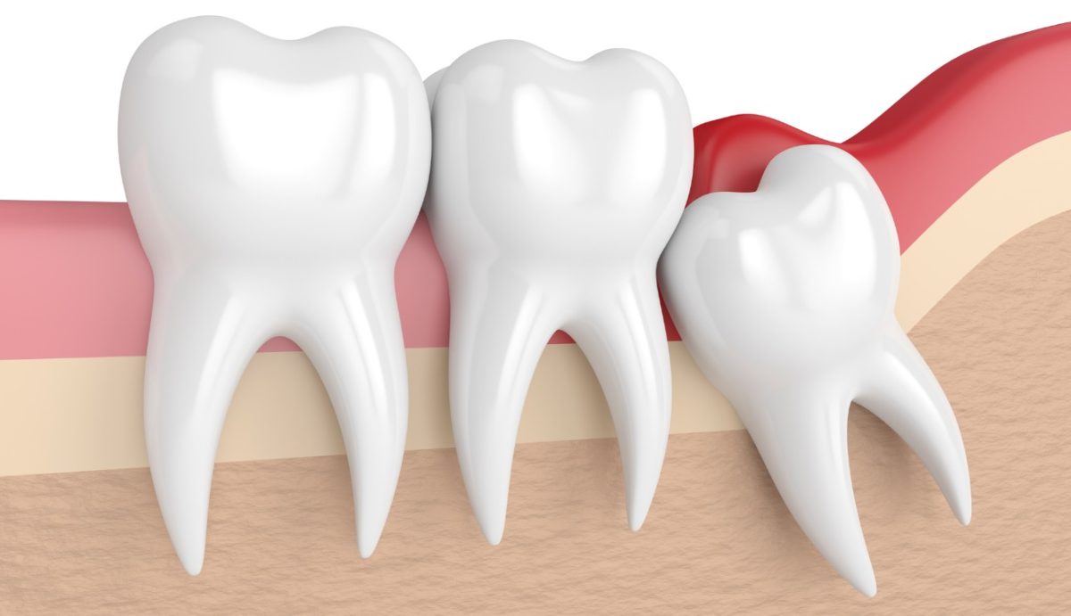 Wisdom Teeth Extraction: Everything You Need to Know