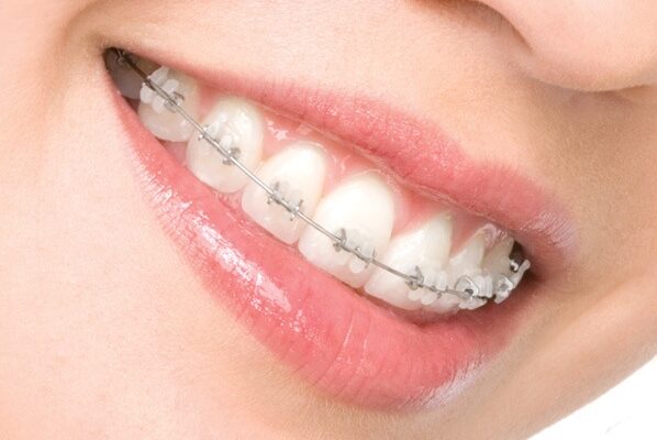 braces