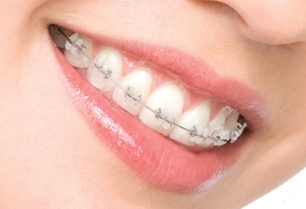 Keeping Your Braces in Ace Condition: A Guide