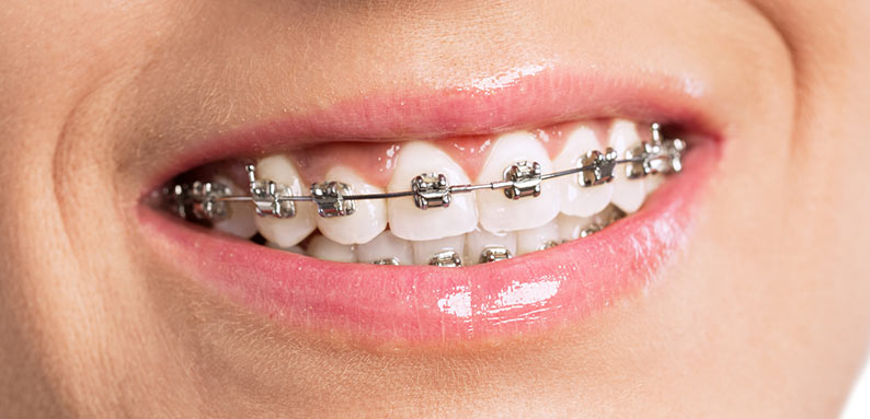 Braces Sparkling: Oral Hygiene with Fixed Appliances