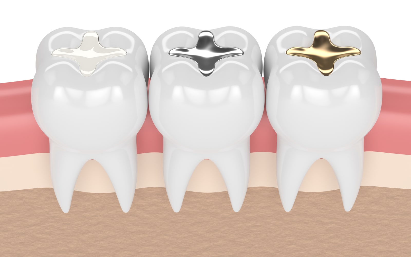 Innovations Transforming Dental Restoration Materials