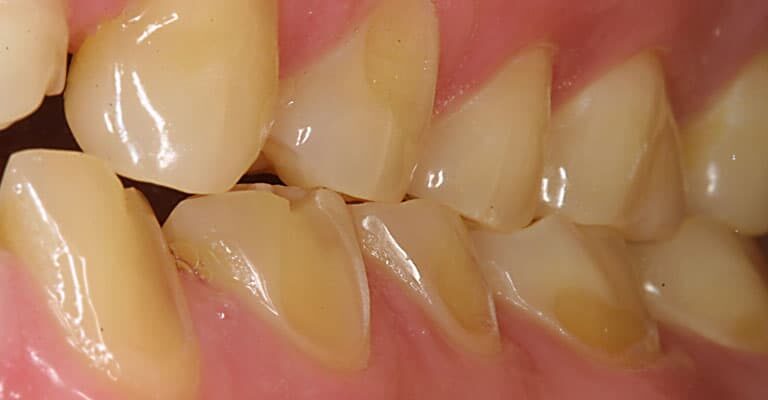 dental erosion