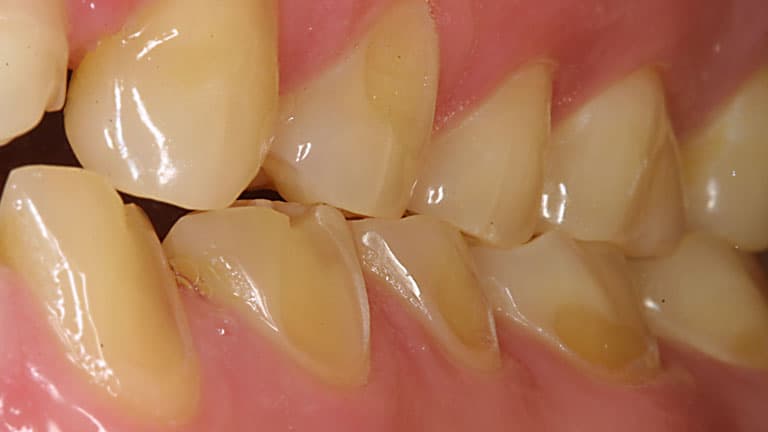 Dental Erosion: Prevention and Treatment Strategies