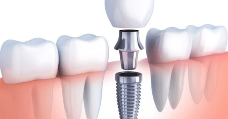 dental implant