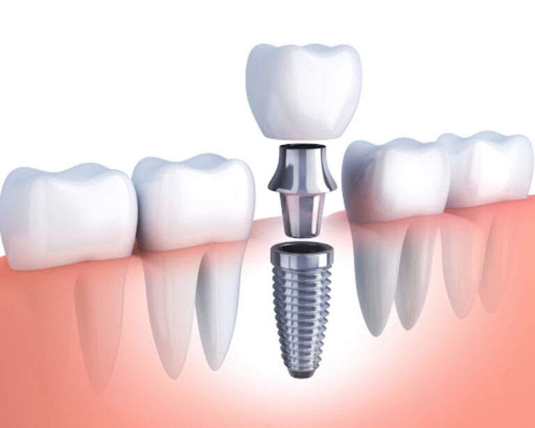 Dental Implant: How Tech Is Transforming Smiles