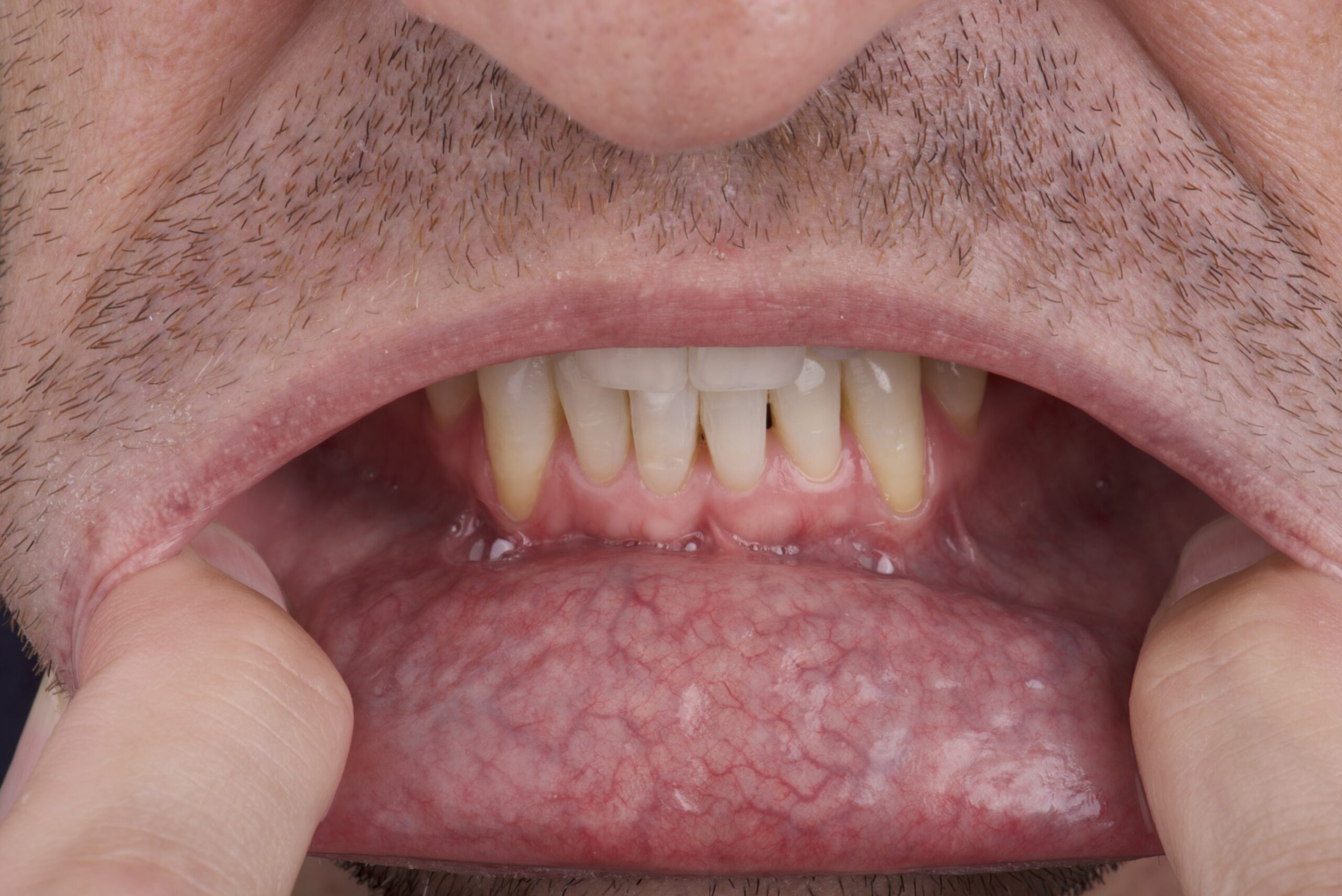 Understanding Oral Cancer: Key Symptoms and Prevention Tips